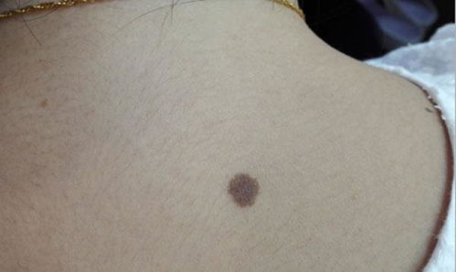 一、 毛发脱落与局部刺激的病理警示