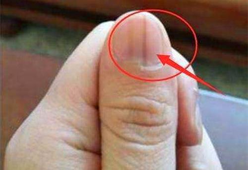 手相指甲扁平与手指纹路有何关联？