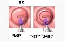 3. 子宫颈炎/宫颈管炎：