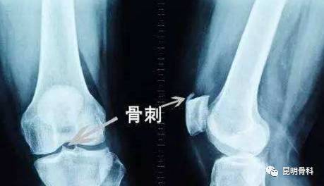 骨质颤动