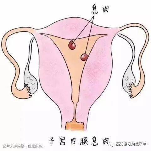 病灶惹祸：息肉、癌变别较小看