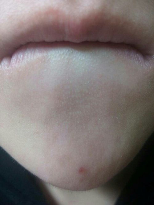 嘴角八字线到下巴的黑痕是什么原因造成的？