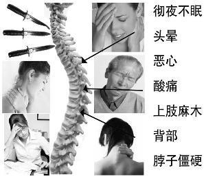 1. 脊髓型颈椎病（信号三）