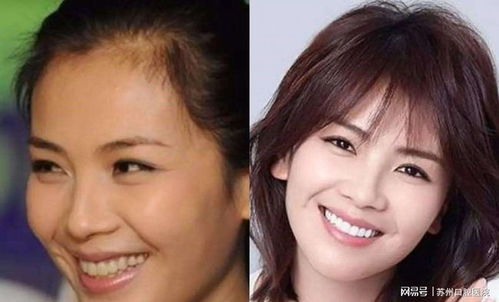 门牙烤瓷后对家居风水有影响吗？