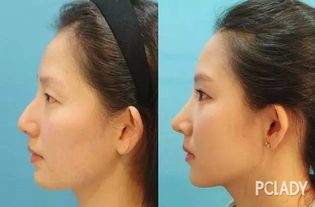 整形美容视角下的塌鼻梁改善
