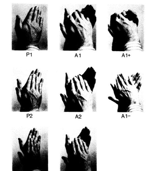 4. 红点状或斑驳型