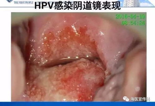 2. 较高危人群尤其要沉重视：