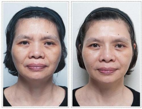 二、  注射填充与肉毒杆菌的应用