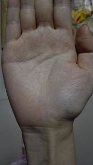 二、  掌心痣与“和合”宿命的探讨