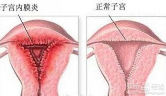 3. 子宫内膜炎