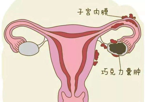 子宫内膜异位症：疼痛与杂乱的双沉重折磨