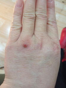 第一章：瘊子的医学成因与临床表现