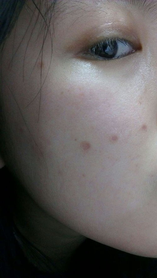 1. 外科手术切除法