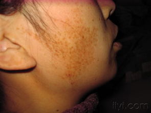 血管性胎记：关注健康风险