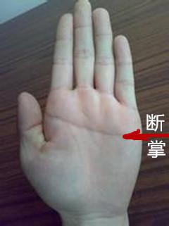 一、 断掌纹的统计出现概率及其结构特征